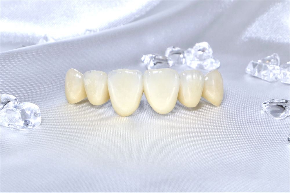セレックシステムを用いた虫歯治療
