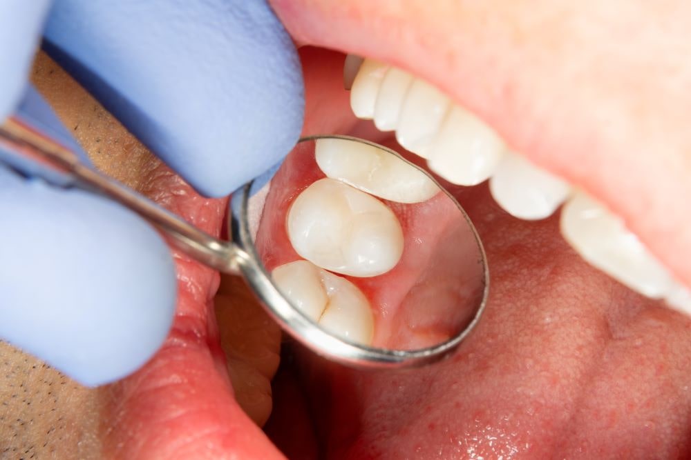 セレックシステムを用いた虫歯治療